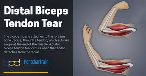 test for bicep tendon tear|imaging for bicep tendon rupture.